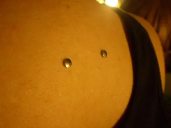 Implant microdermal à Aubagne